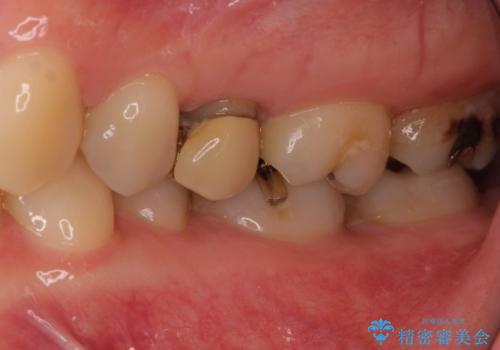 大きな虫歯で歯が欠けた　神経を極力残した治療の治療前