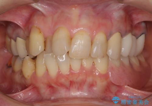 ノンクラスプデンチャー(金属止め具のない入れ歯)で左側の咬合回復の治療後