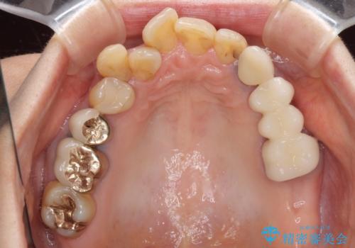 ノンクラスプデンチャー(金属止め具のない入れ歯)で左側の咬合回復の治療後