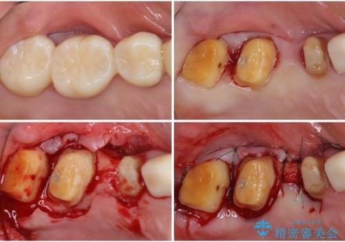 奥歯の歯槽骨が失われた 歯周外科処置後のセラミックブリッジの治療前