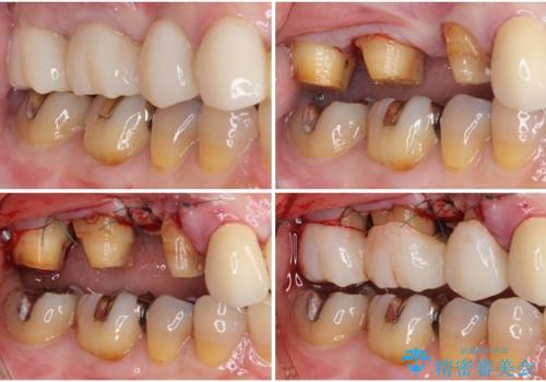 奥歯の歯槽骨が失われた 歯周外科処置後のセラミックブリッジの治療後