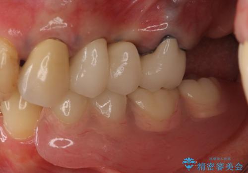 ノンクラスプデンチャー(金属止め具のない入れ歯)で左側の咬合回復の治療後