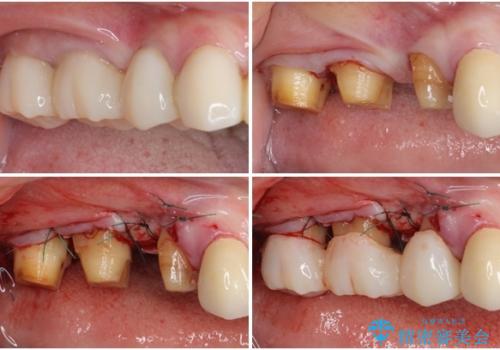 奥歯の歯槽骨が失われた　歯周外科処置後のセラミックブリッジの治療中