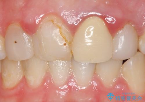 オールセラミッククラウン 前歯を綺麗に 神経が死んだ歯の再治療~補綴の治療前