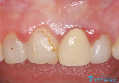 オールセラミッククラウン 前歯を綺麗に 神経が死んだ歯の再治療~補綴の症例 治療前