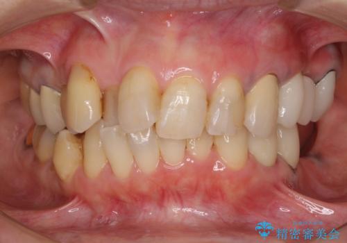 ノンクラスプデンチャー(金属止め具のない入れ歯)で左側の咬合回復の治療中