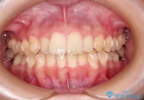 出ている前歯をインビザラインにて引っ込めるの治療中