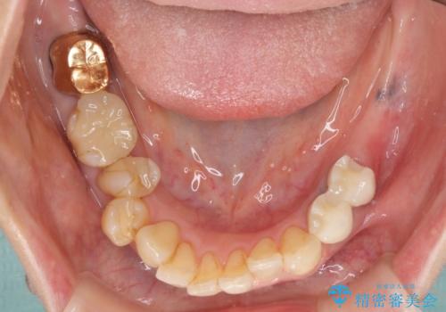 ノンクラスプデンチャー(金属止め具のない入れ歯)で左側の咬合回復の治療中