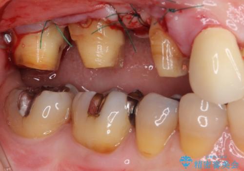 奥歯の歯槽骨が失われた 歯周外科処置後のセラミックブリッジの治療中