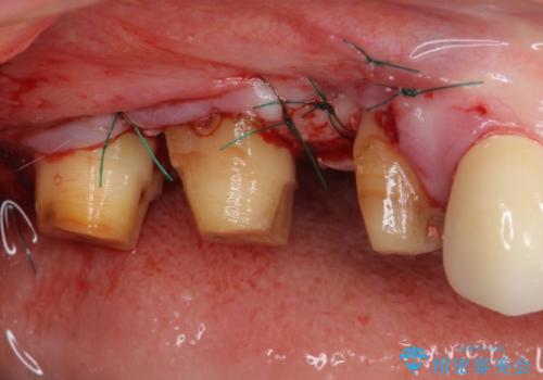 奥歯の歯槽骨が失われた　歯周外科処置後のセラミックブリッジの治療中