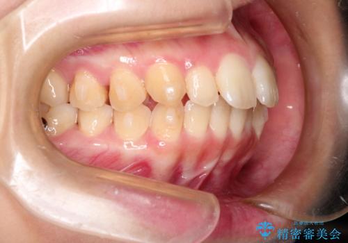 出ている前歯をインビザラインにて引っ込めるの治療中
