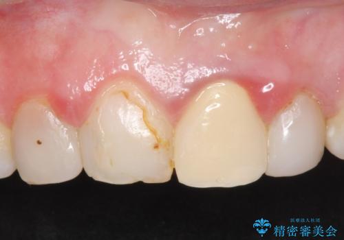 オールセラミッククラウン 前歯を綺麗に 神経が死んだ歯の再治療~補綴の治療前