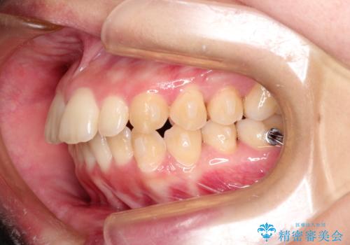 出ている前歯をインビザラインにて引っ込めるの治療中