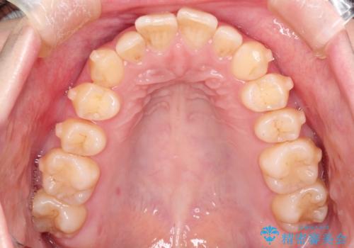 出ている前歯をインビザラインにて引っ込めるの治療中