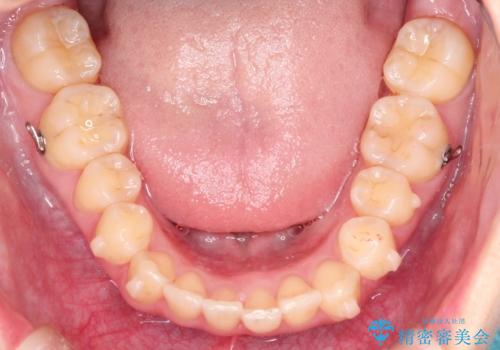 出ている前歯をインビザラインにて引っ込めるの治療中