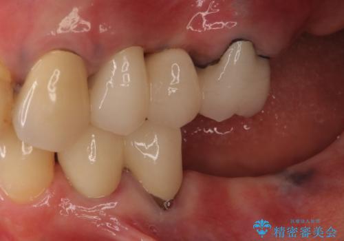 ノンクラスプデンチャー(金属止め具のない入れ歯)で左側の咬合回復の治療中