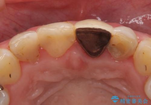 オールセラミッククラウン 前歯を綺麗に 神経が死んだ歯の再治療~補綴の治療前
