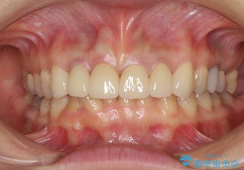深い虫歯と不自然な色調の前歯　オールセラミッククラウンで自然にの治療後
