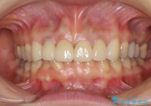 深い虫歯と不自然な色調の前歯 オールセラミッククラウンで自然にの治療後