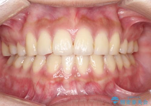 横顔をすっきりさせたい 下の前歯が1本少ない方の変則的な抜歯矯正の治療後