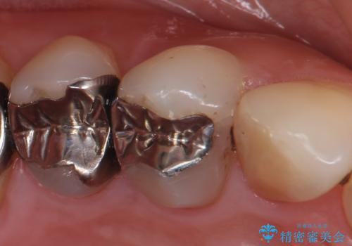 オールセラミッククラウン(エクセレント) 神経まで達してしまった虫歯の治療の治療前