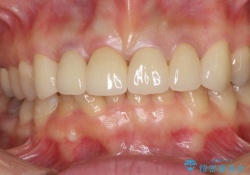 深い虫歯と不自然な色調の前歯 オールセラミッククラウンで自然にの治療後