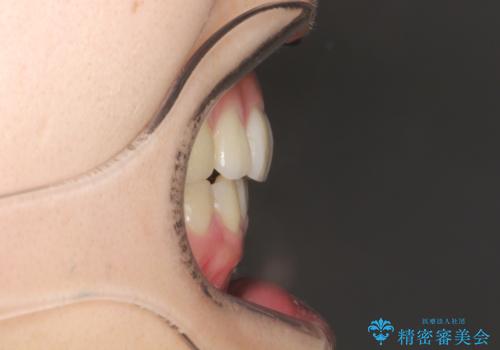 横顔をすっきりさせたい　下の前歯が1本少ない方の変則的な抜歯矯正の治療後