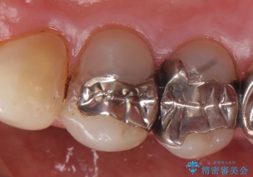 オールセラミッククラウン(エクセレント) 神経まで達してしまった虫歯の治療の治療前