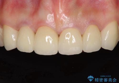 深い虫歯と不自然な色調の前歯　オールセラミッククラウンで自然にの症例 治療後