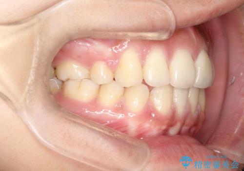 横顔をすっきりさせたい　下の前歯が1本少ない方の変則的な抜歯矯正の症例 治療後