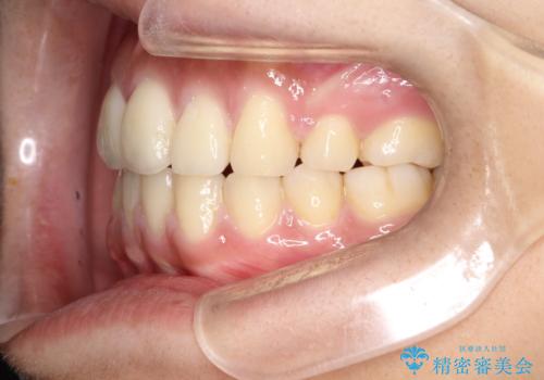 横顔をすっきりさせたい 下の前歯が1本少ない方の変則的な抜歯矯正の治療後