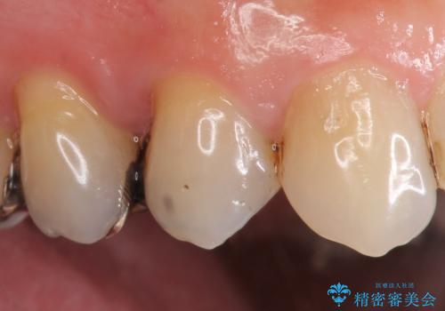 オールセラミッククラウン(エクセレント) 神経まで達してしまった虫歯の治療の治療前