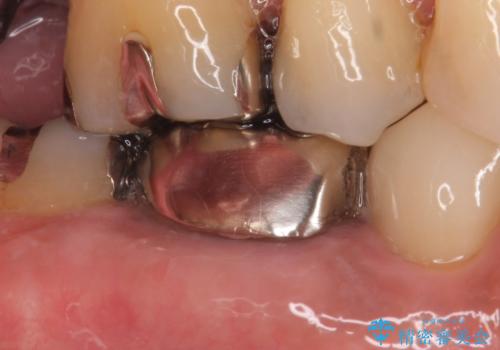 オールセラミッククラウン 咬むと疼く銀歯の治療の治療前