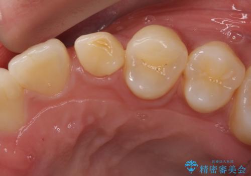 インビザライン矯正とインプラント治療と 総合歯科治療の治療前
