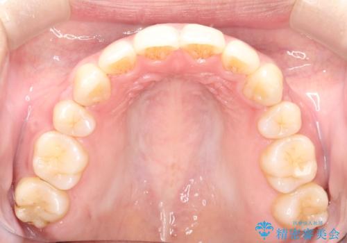 横顔をすっきりさせたい 下の前歯が1本少ない方の変則的な抜歯矯正の治療後