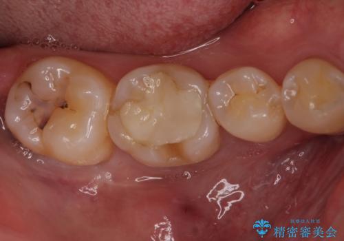 セラミックインレーやりかえ　虫歯の除去をしっかりとの症例 治療前