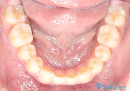 横顔をすっきりさせたい 下の前歯が1本少ない方の変則的な抜歯矯正の治療後