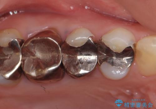 オールセラミッククラウン 咬合痛のある歯の治療の治療前