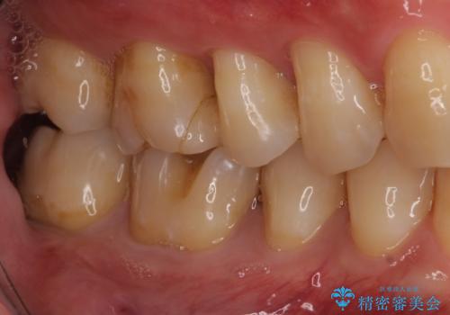 セラミックインレーやりかえ 虫歯の除去をしっかりとの治療前