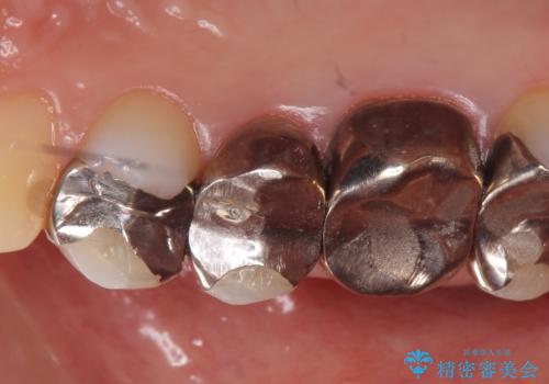 オールセラミッククラウン 咬合痛のある歯の治療の治療前