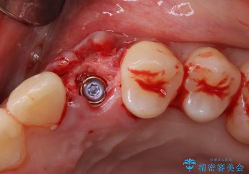 インビザライン矯正とインプラント治療と 総合歯科治療の治療中