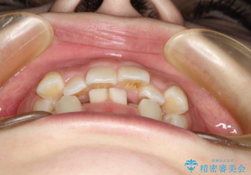 目立たない裏側矯正　抜歯矯正で口元を改善の治療前