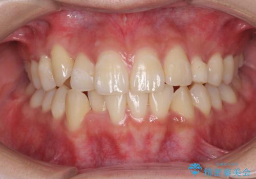 インビザライン矯正とインプラント治療と 総合歯科治療の治療中