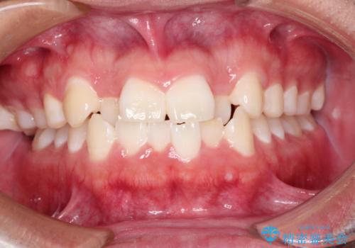 前歯のガタガタを目立たずきれいにしたい　インビザラインによる見えない矯正の症例 治療前