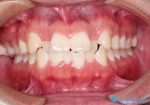 前歯のガタガタを目立たずきれいにしたい　インビザラインによる見えない矯正の治療前