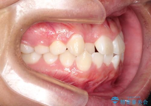 前歯のガタガタを目立たずきれいにしたい インビザラインによる見えない矯正の治療前