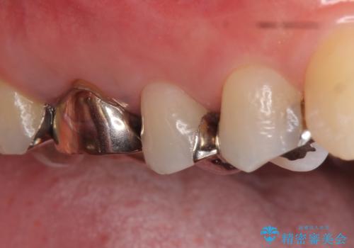 オールセラミッククラウン　咬合痛のある歯の治療の症例 治療前