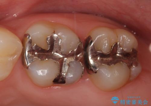 セラミックインレー　銀歯の下の縁下カリエス(歯茎より深い虫歯)の治療の症例 治療前