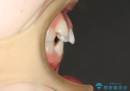 目立たない裏側矯正 抜歯矯正で口元を改善の治療前