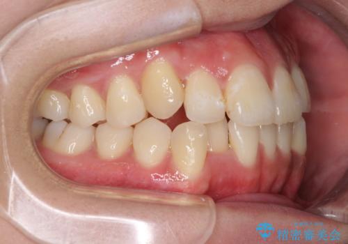 インビザライン矯正とインプラント治療と 総合歯科治療の治療中